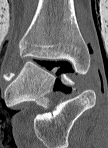 CT Talar Dome Fracture 2